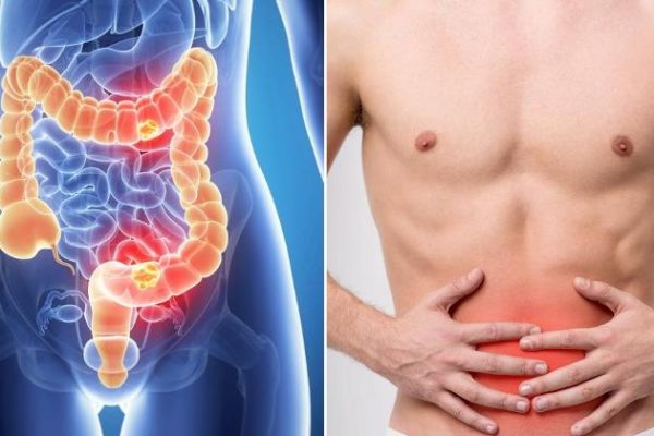 7 Langkah Mengurangi Risiko Penyakit Usus