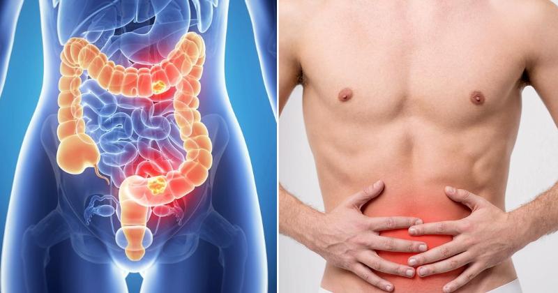 7 Langkah Mengurangi Risiko Penyakit Usus