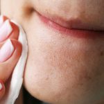 10 Cara Mencegah Komedo di Dagu Secara Efektif