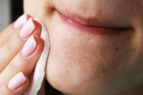10 Cara Mencegah Komedo di Dagu Secara Efektif 10 Cara Mencegah Komedo di Dagu Secara Efektif