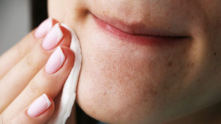 10 Cara Mencegah Komedo di Dagu Secara Efektif