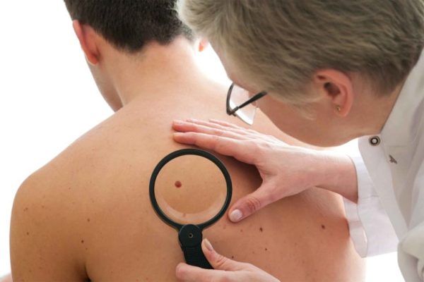 10 Gejala Kanker Kulit dan Cara Melindungi Diri 10 Gejala Kanker Kulit dan Cara Melindungi Diri