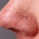 7 Cara Alami Menghilangkan Jerawat di Hidung
