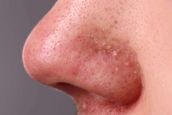 7 Cara Alami Menghilangkan Jerawat di Hidung