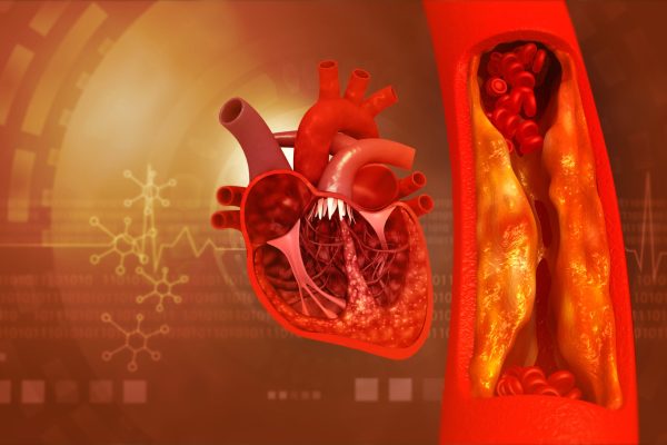 5 Tips untuk Penderita Penyakit Pembuluh Darah 5 Tips untuk Penderita Penyakit Pembuluh Darah