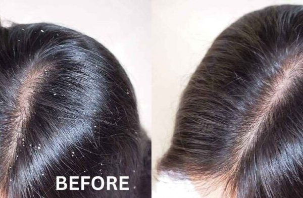 10 Tips Rambut Bebas Ketombe dan Tetap Lembut 10 Tips Rambut Bebas Ketombe dan Tetap Lembut