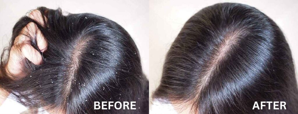 10 Tips Rambut Bebas Ketombe dan Tetap Lembut
