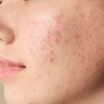 10 Cara Menyamarkan Bekas Jerawat Secara Alami