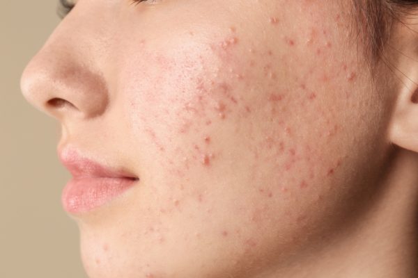 10 Cara Menyamarkan Bekas Jerawat Secara Alami 10 Cara Menyamarkan Bekas Jerawat Secara Alami